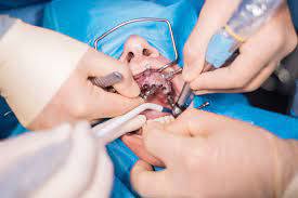 Hands on Oral Surgery