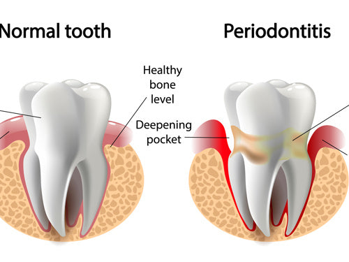 CPD Cardiff - Minimally Invasive Non-surgical Periodontal Treatment (MINST) - 11th December 2024